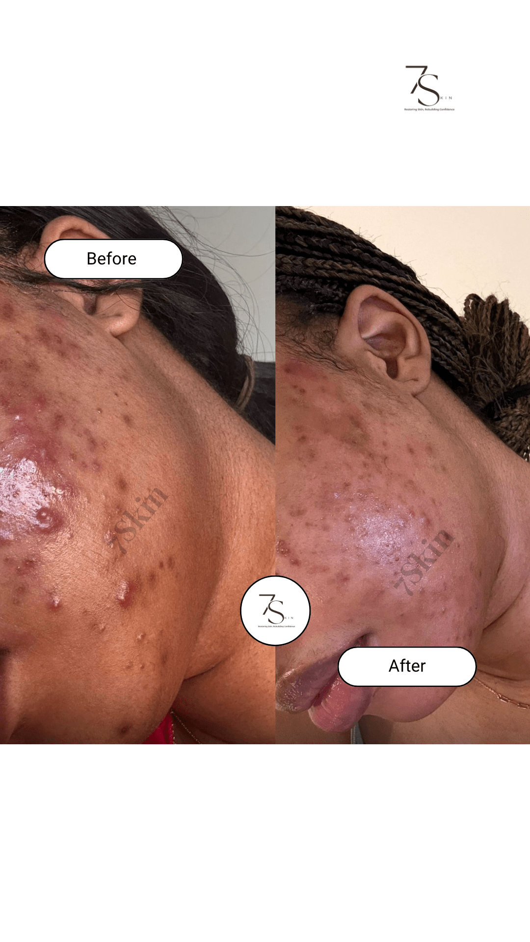acne_treatment_2 (3)